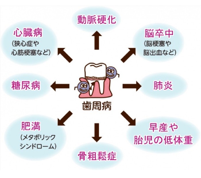 歯周病から発生する様々な疾患のイラスト図