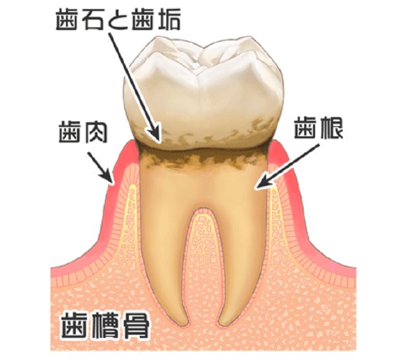 歯肉炎のイラスト図