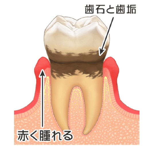 軽度歯周炎のイラスト図
