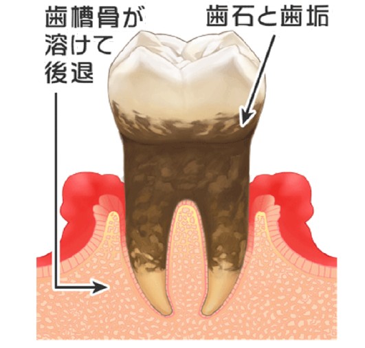 中等度歯周炎のイラスト図