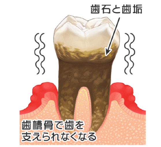 重度歯周炎のイラスト図