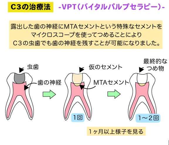C3の治療法（VPTのイラスト図）