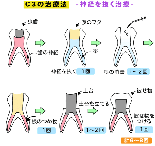 C3で神経を抜く治療の手順イラスト図