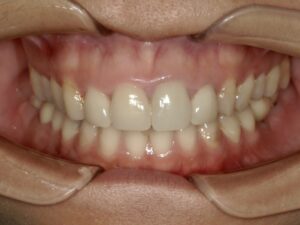 印西市・千葉ニュータウンでセラミック治療をお考えの方へ