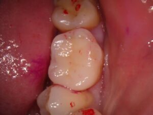 印西市・千葉ニュータウンでセラミック治療をお考えの方へ